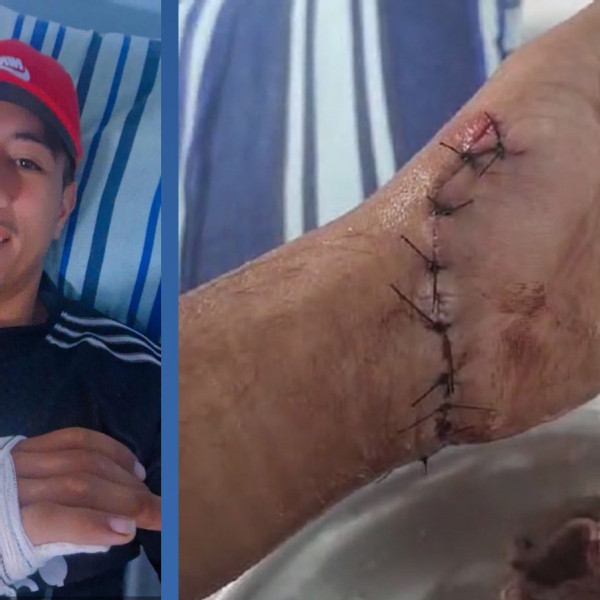 Corumbá: “Sem vaga” para cirurgia especial, jovem corre o risco de ficar aleijado de uma mão