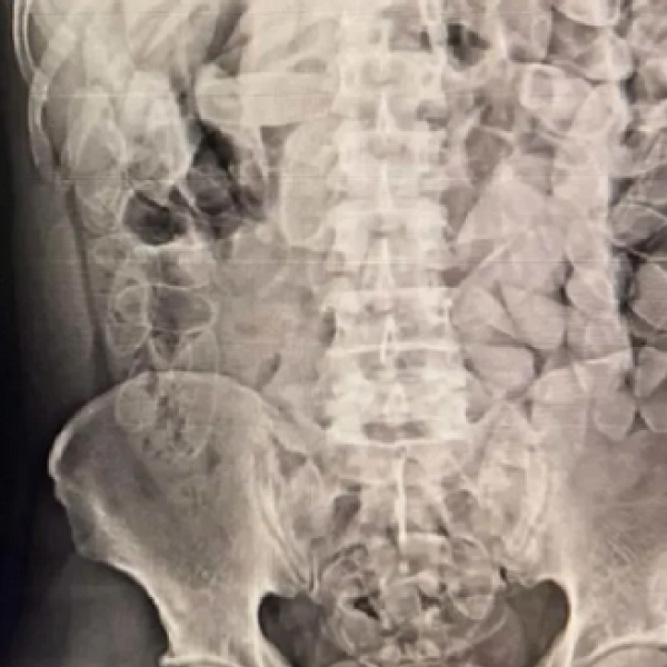 Três bolivianos são flagrados transportando cápsulas de cocaína no corpo em Corumbá